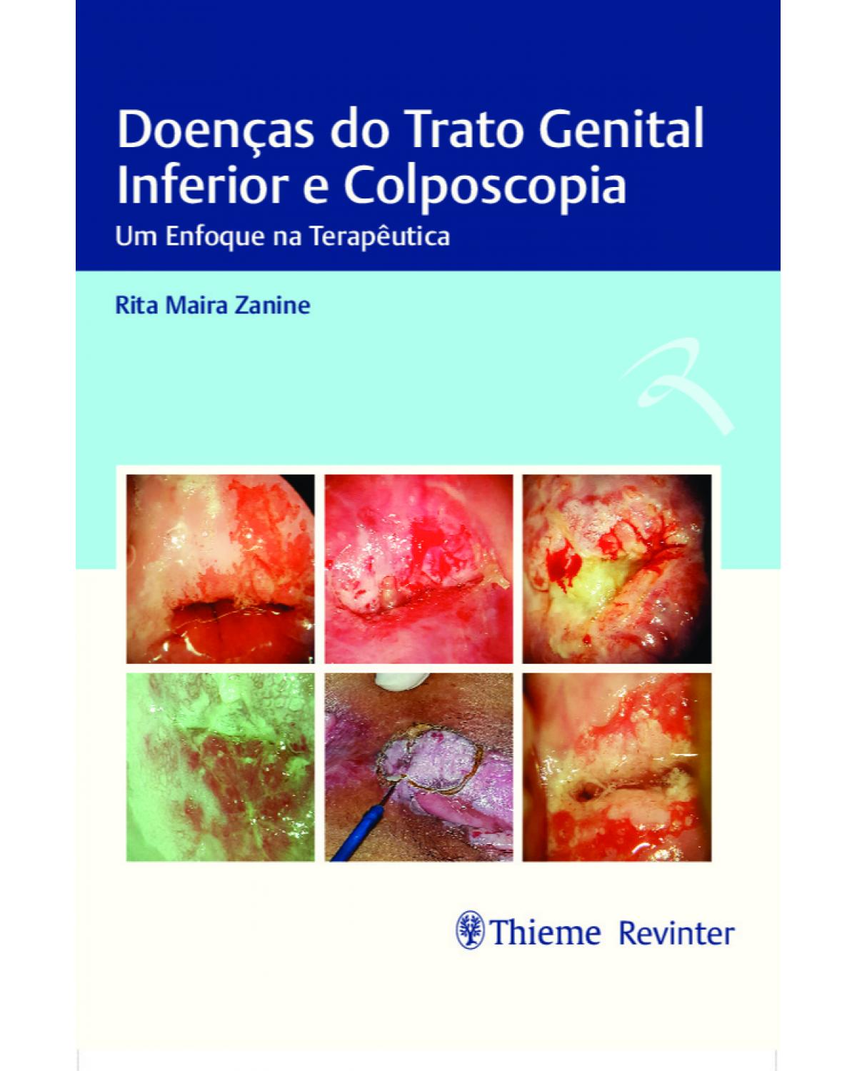 Doenças do trato genital inferior e colposcopia - um enfoque na terapêutica - 1ª Edição | 2020