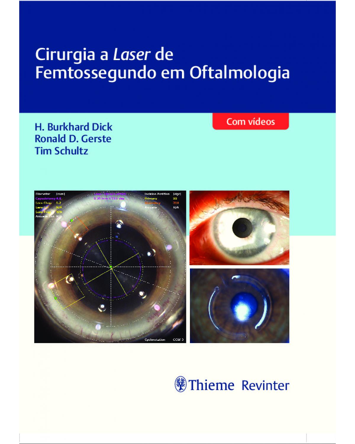 Cirurgia a laser de femtossegundo em oftalmologia - 1ª Edição | 2021