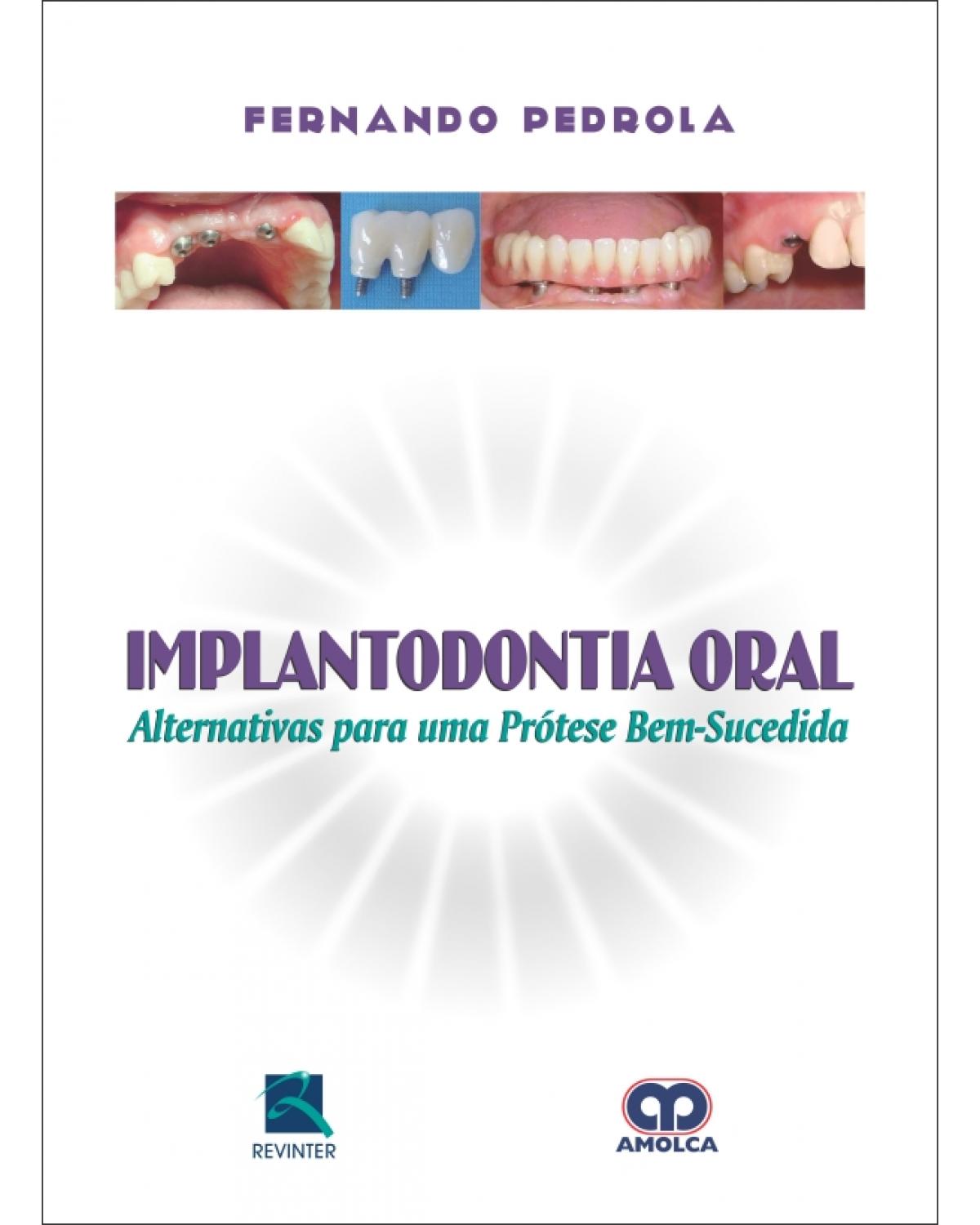 Implantodontia oral - alternativas para uma prótese bem-sucedida - 1ª Edição | 2011