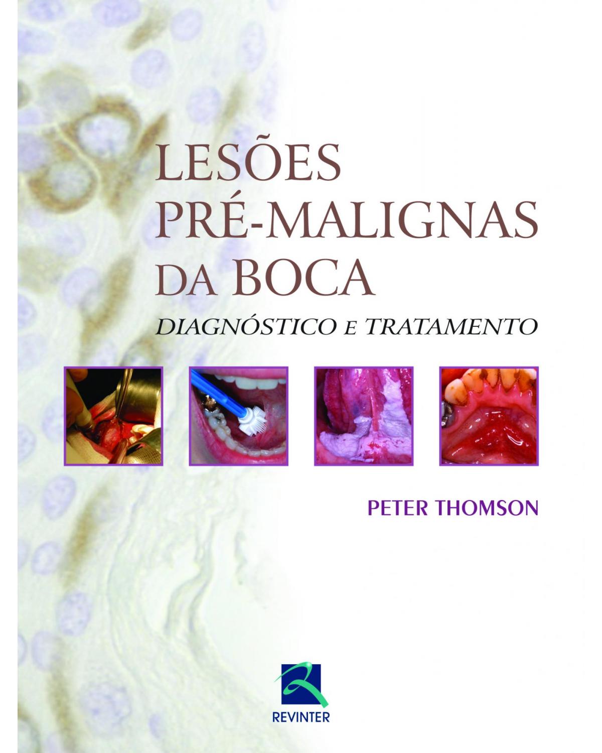 Lesões pré-malignas da boca - diagnóstico e tratamento - 1ª Edição | 2013