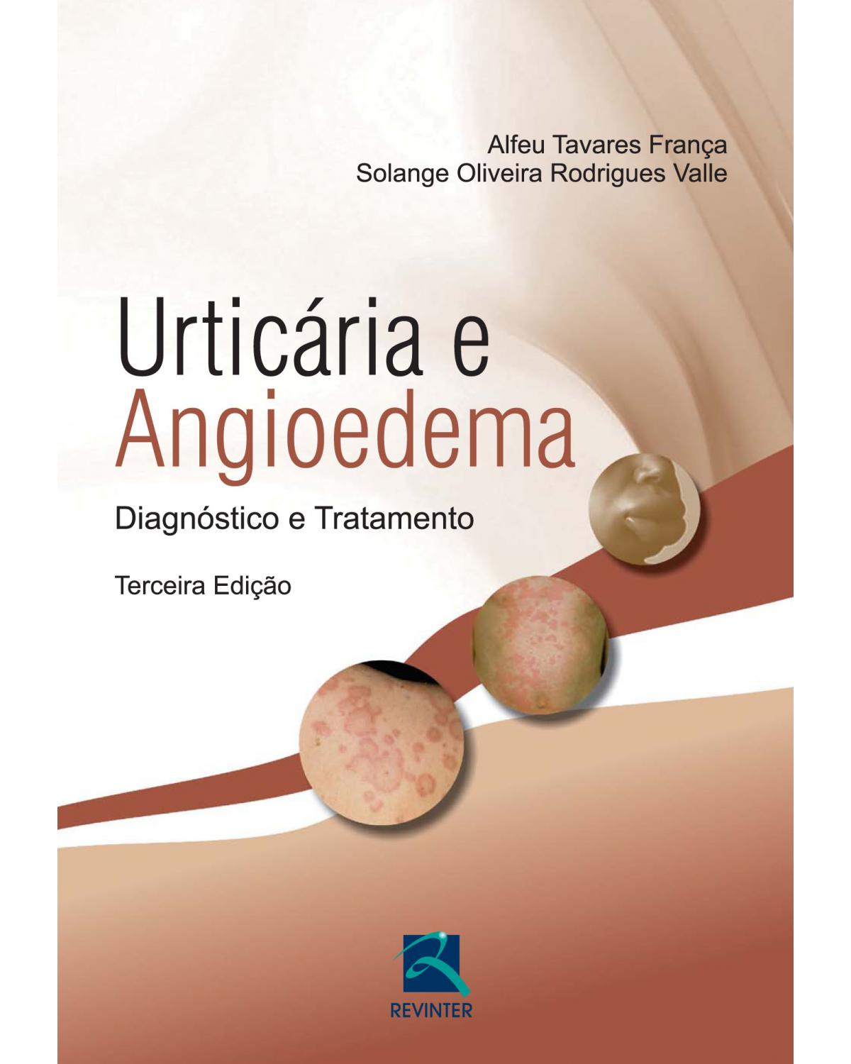 Urticária e angiodema - diagnóstico e tratamento - 3ª Edição | 2014