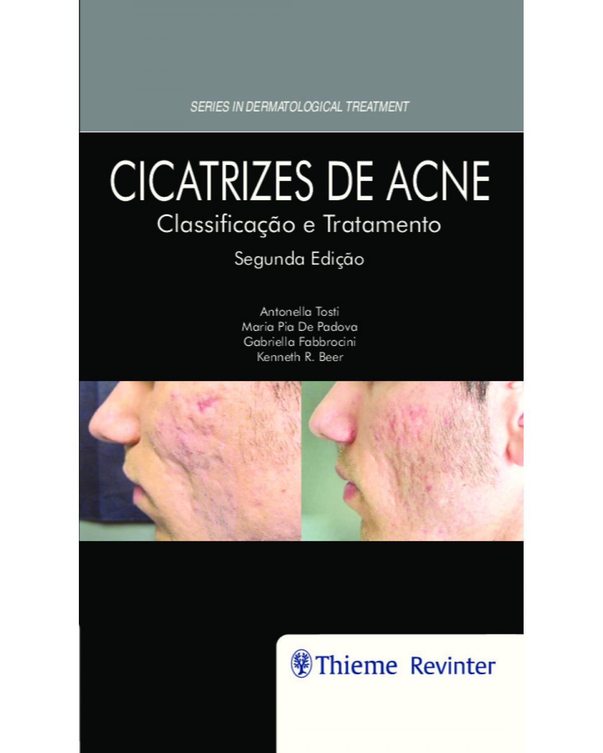 Cicatrizes de acne - classificação e tratamento - 2ª Edição | 2019