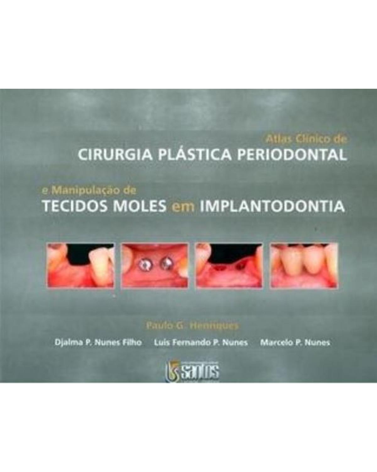 Atlas clínico de cirurgia plástica periodontal - E manipulação de tecidos moles em implantodontia - 1ª Edição | 2007